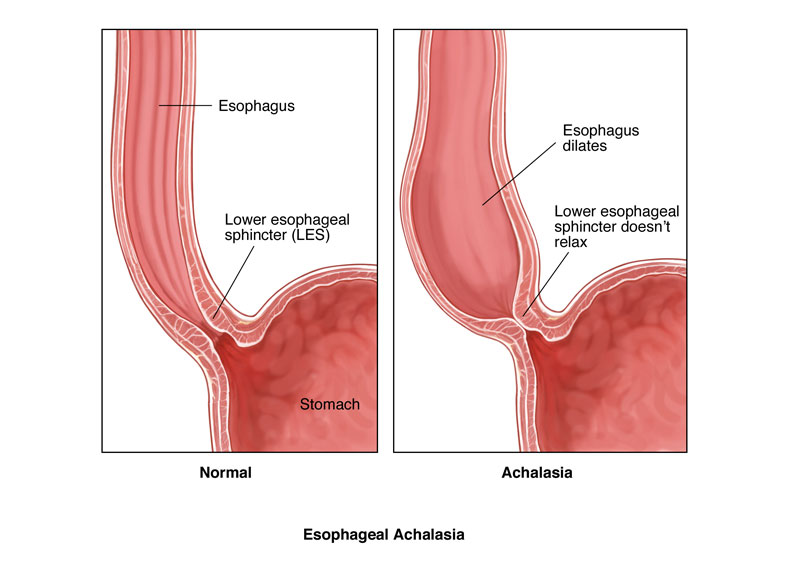 achalasia