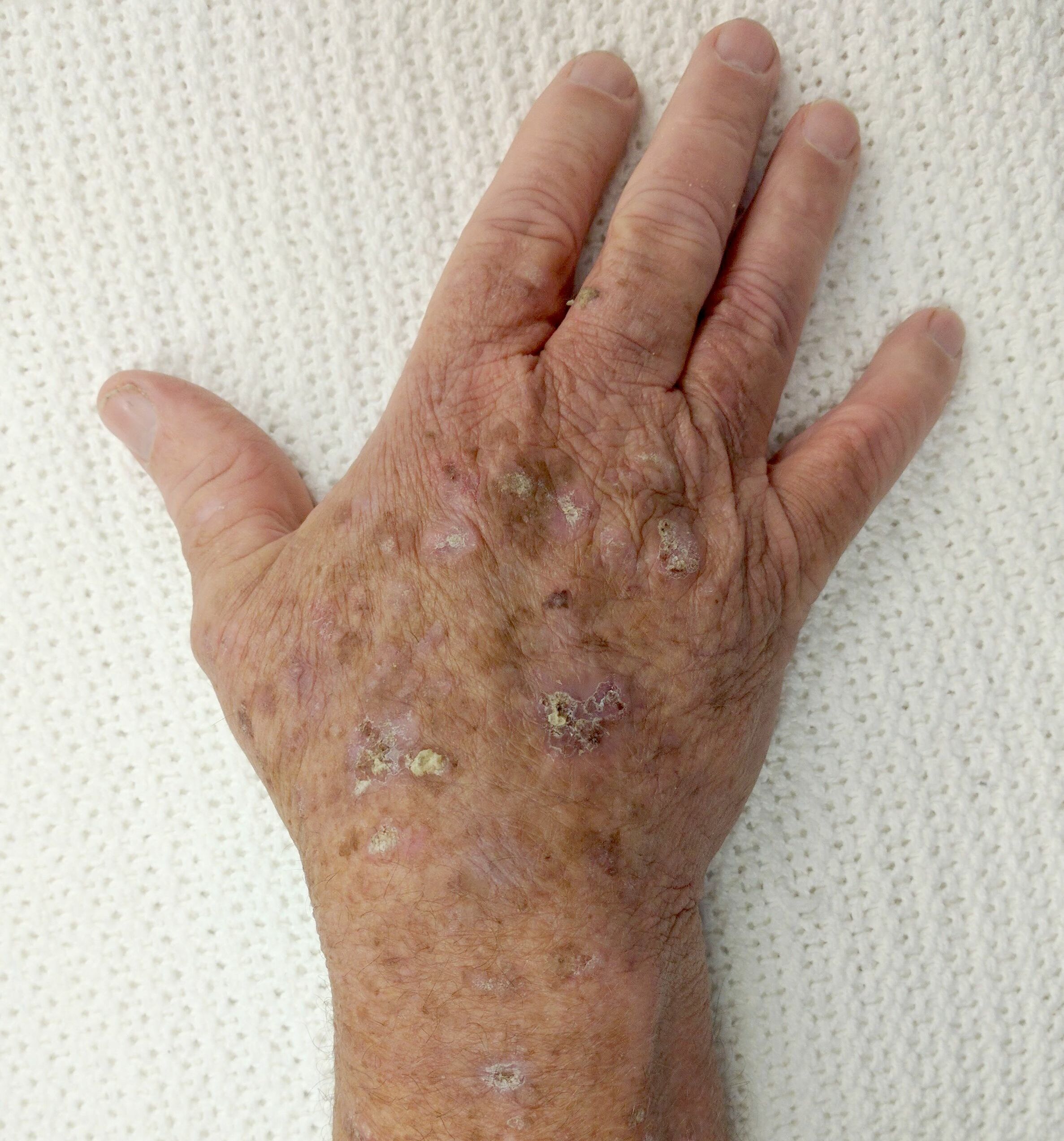 actinic keratosis