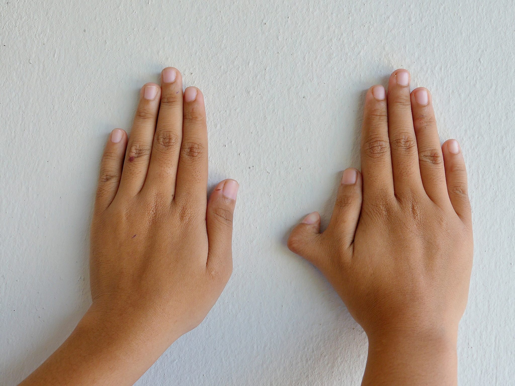 Congenital Hand Differences