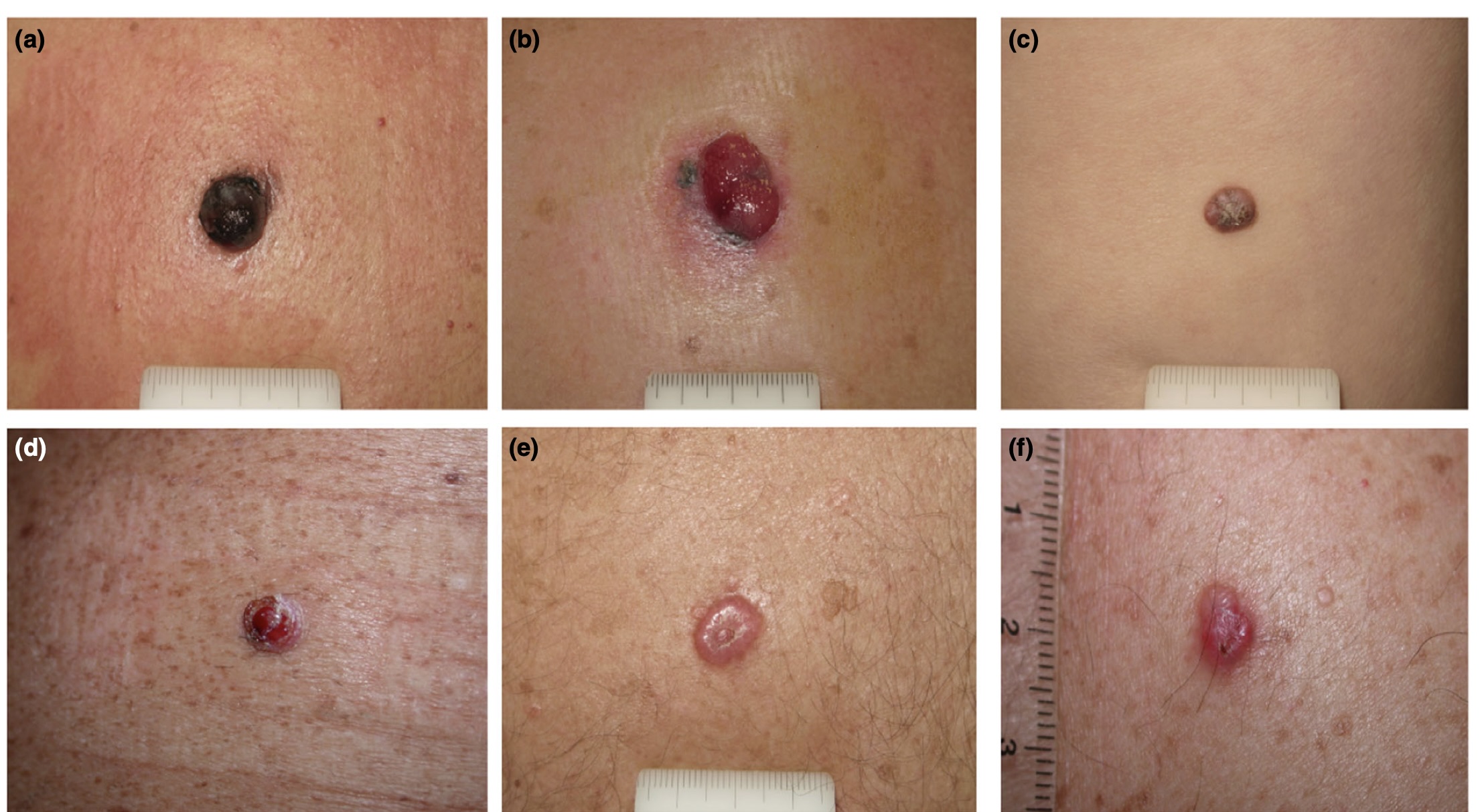 Nodular Melanoma