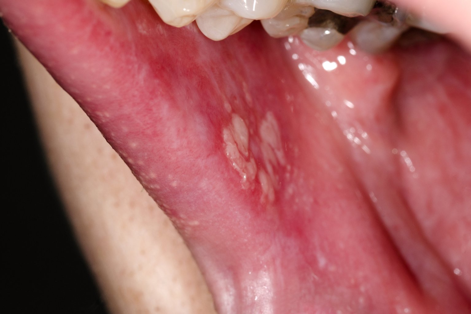 Oral Lichen Planus