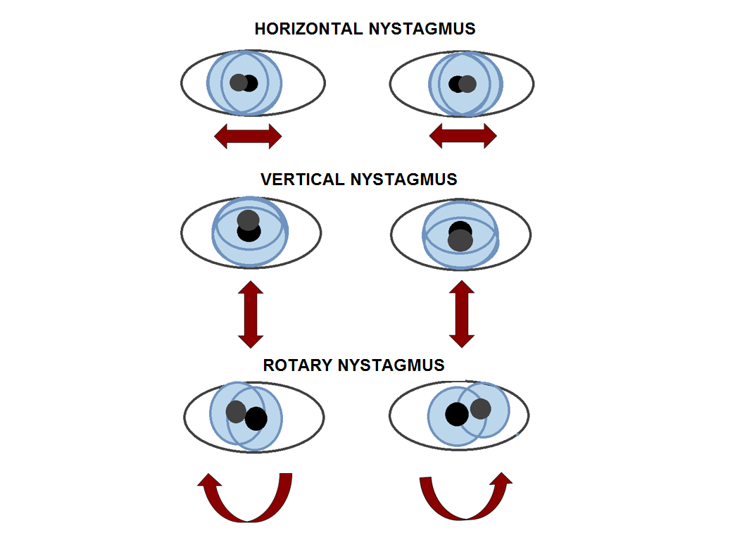 nystagmus