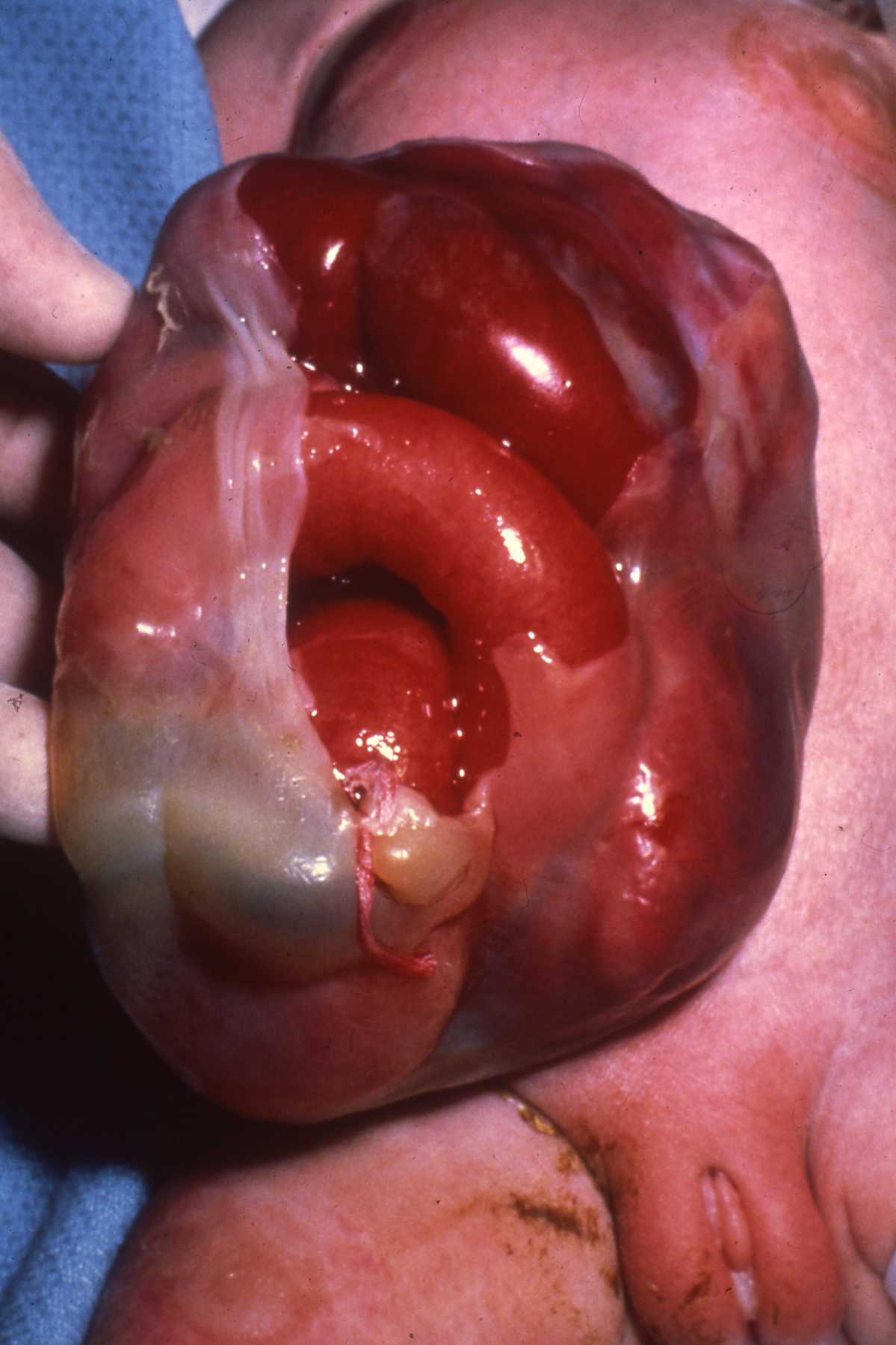 omphalocele