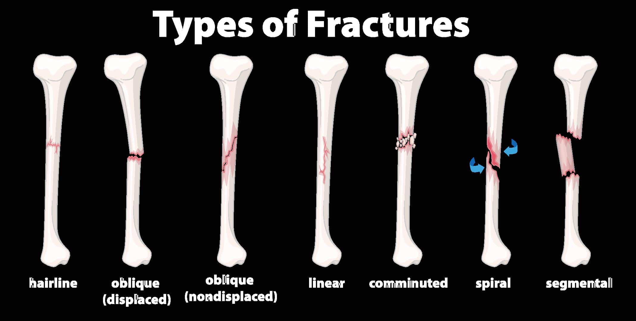 Bone Fractures