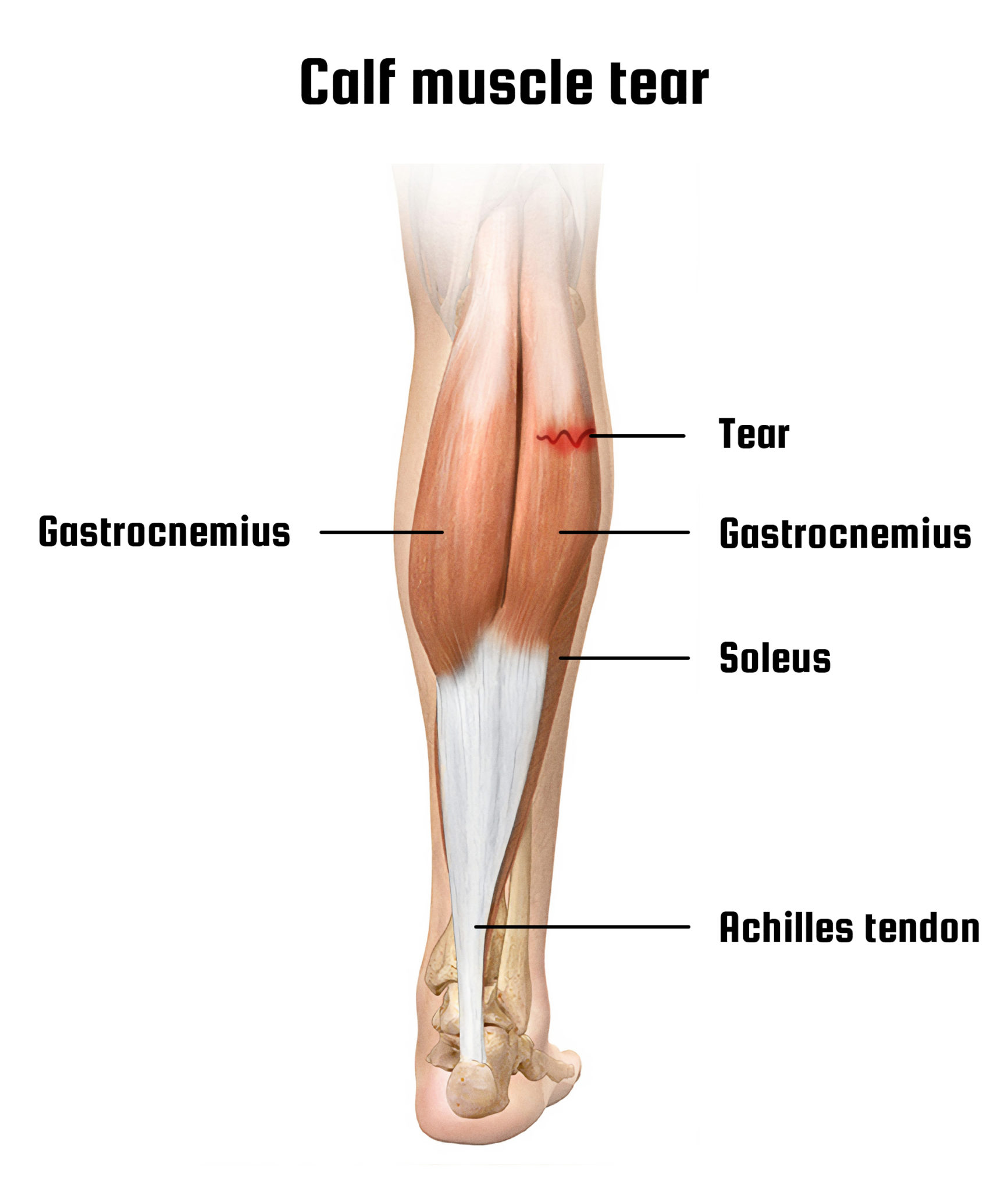 CALF MUSCULE TEAR