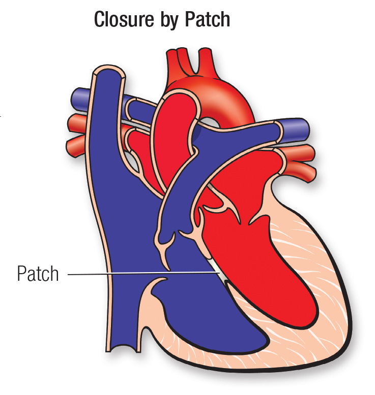 Closure by Patch