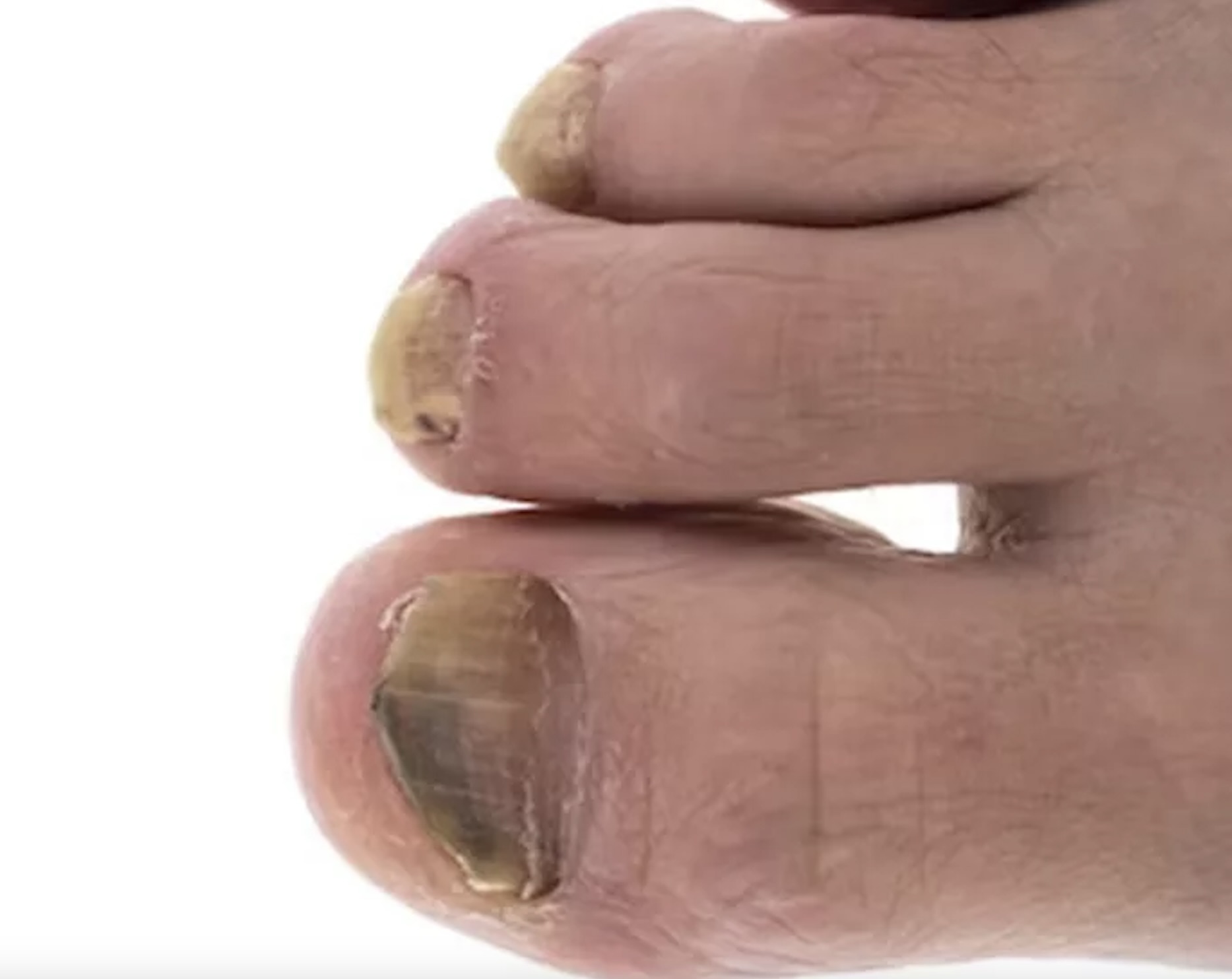 Discolored Toenails