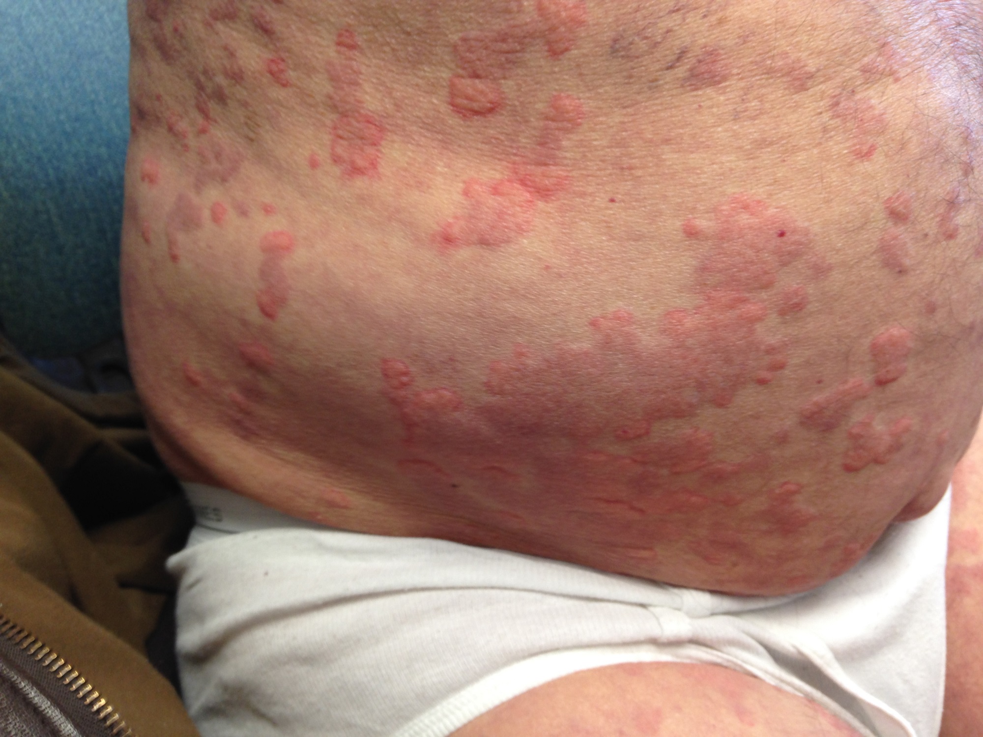 Erythematous Rash