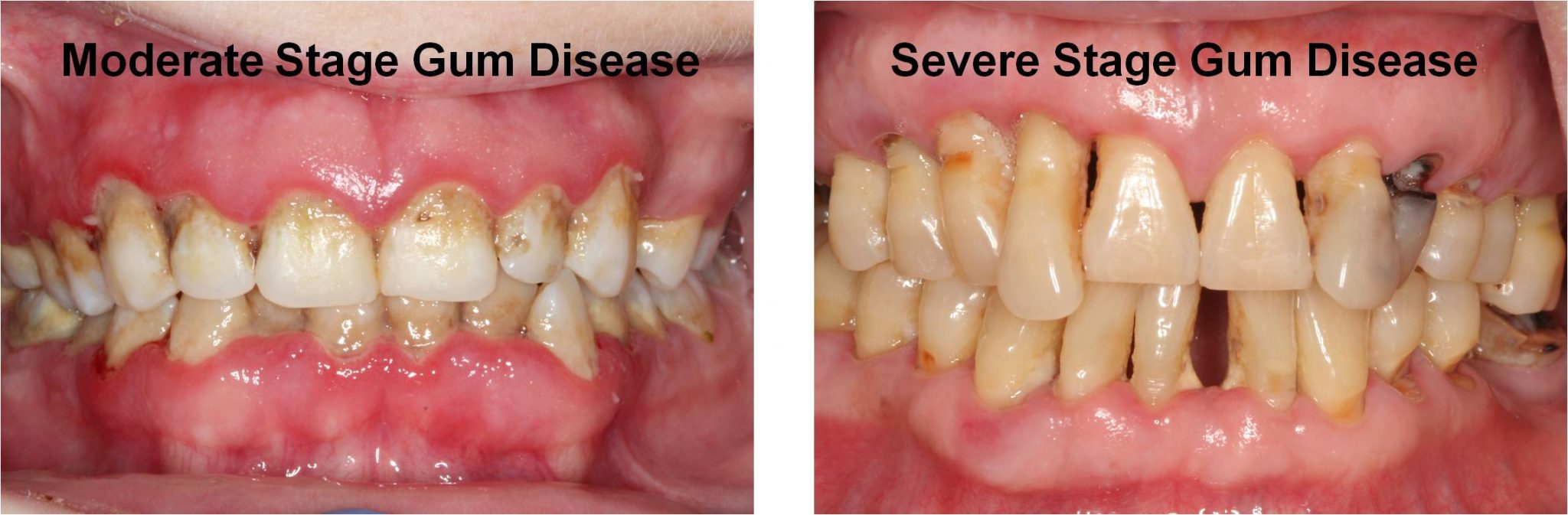 Gum Disease