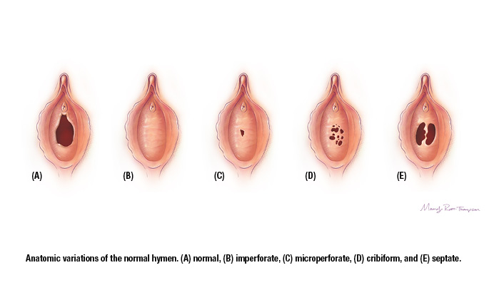 Hymen