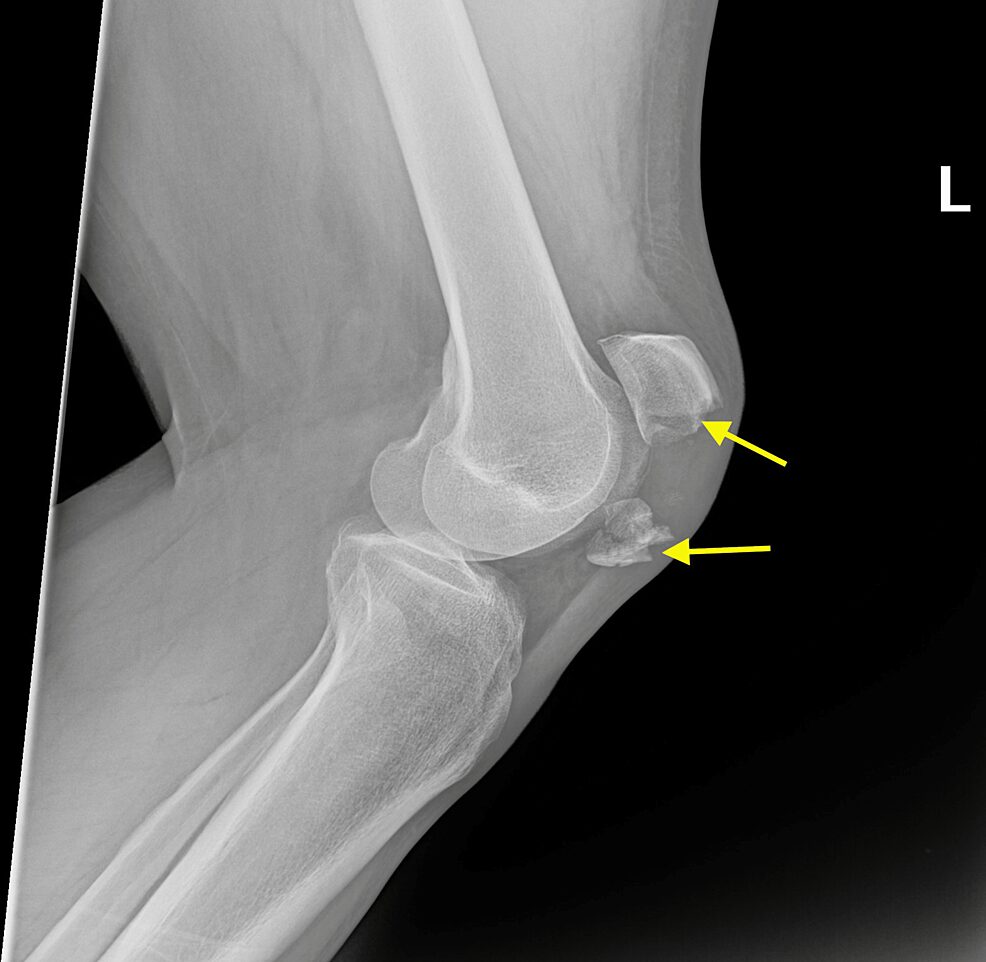 Kneecap Fracture