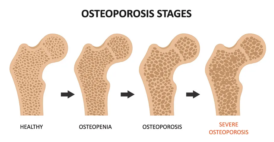 Osteoporosis