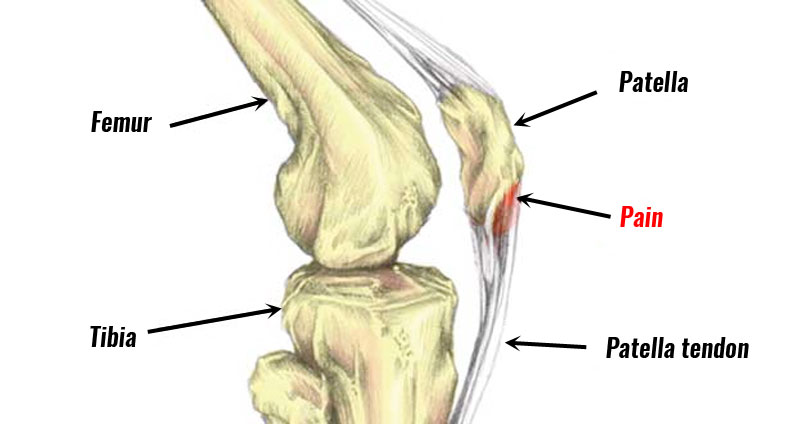 Patellar Tendonitis