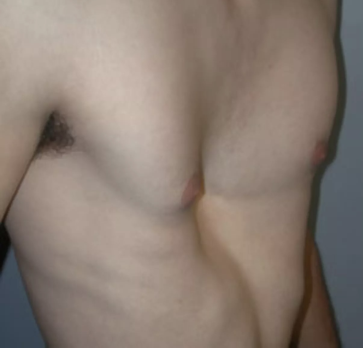 Pectus Excavatum