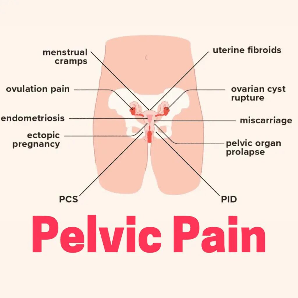 Pelvic Pain