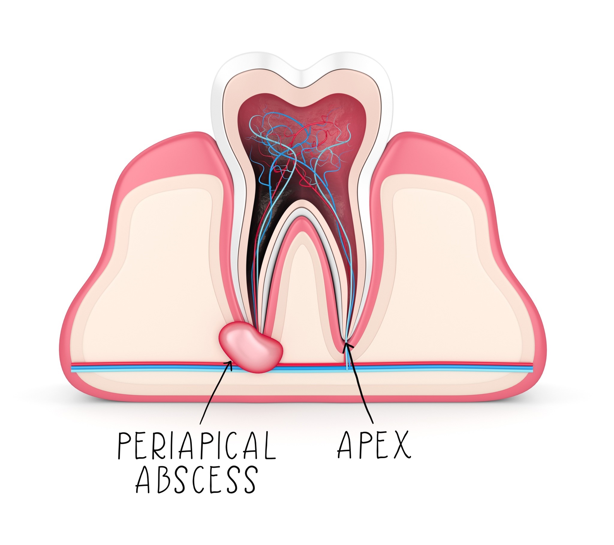 Periapical Abscess