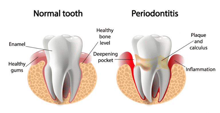 Periodontitis