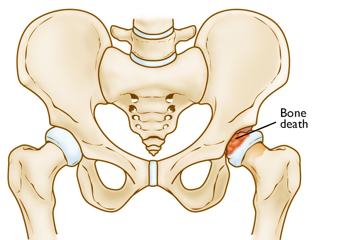 Perthes disease