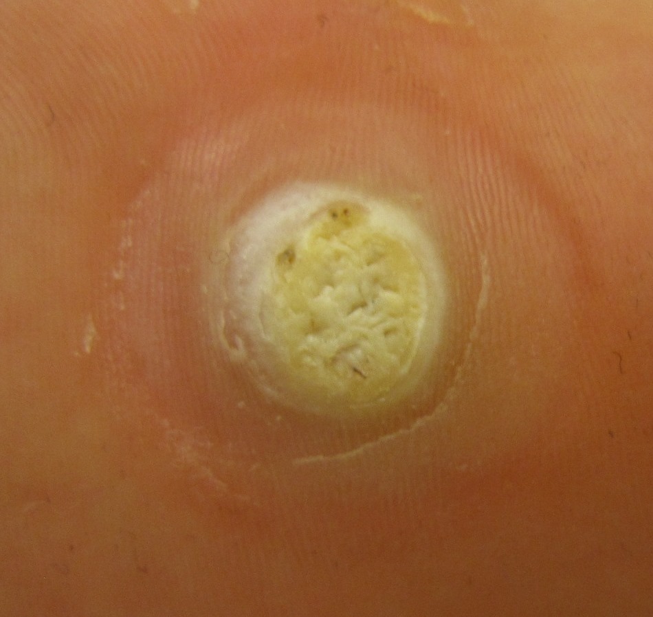 Plantar Warts