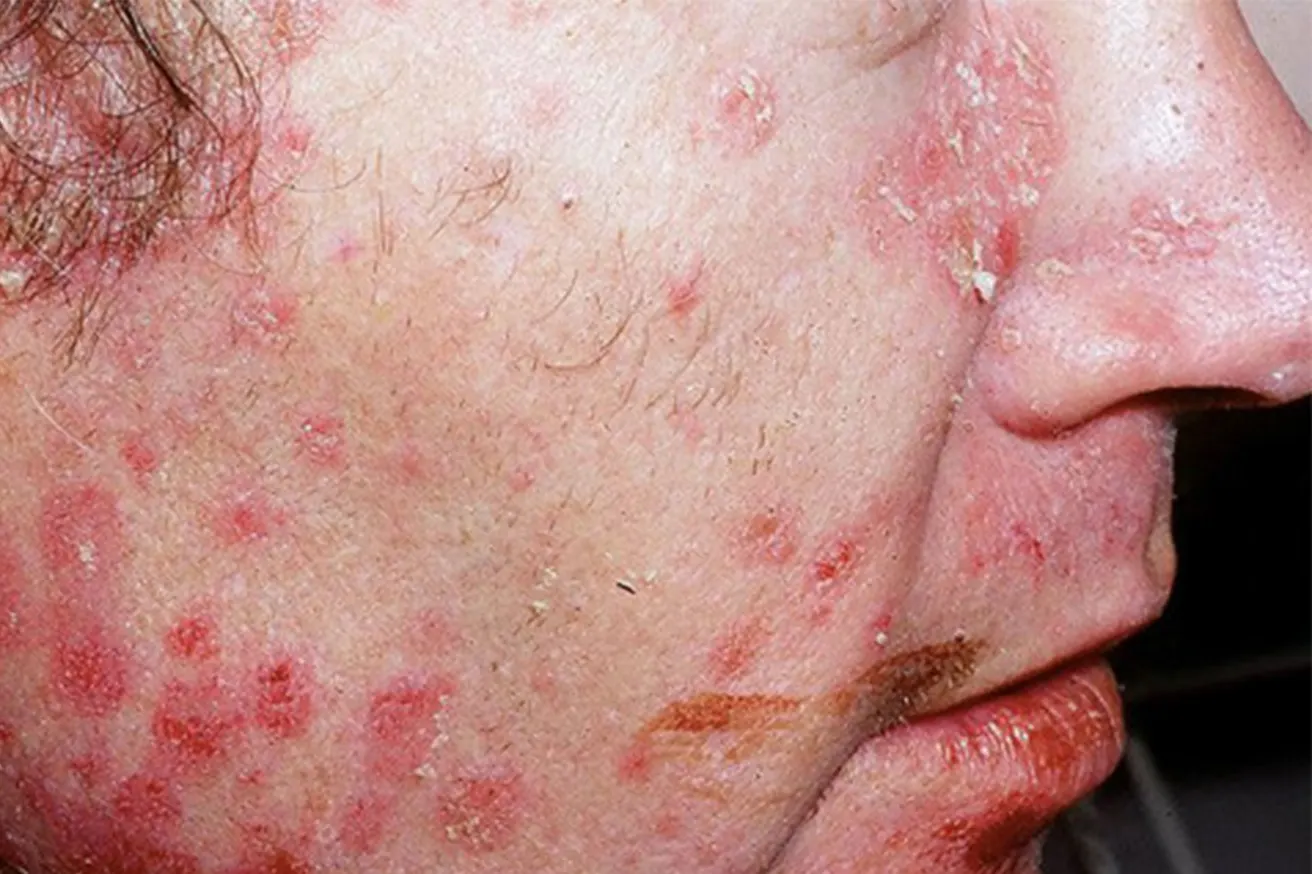 Psoriasis on the Face