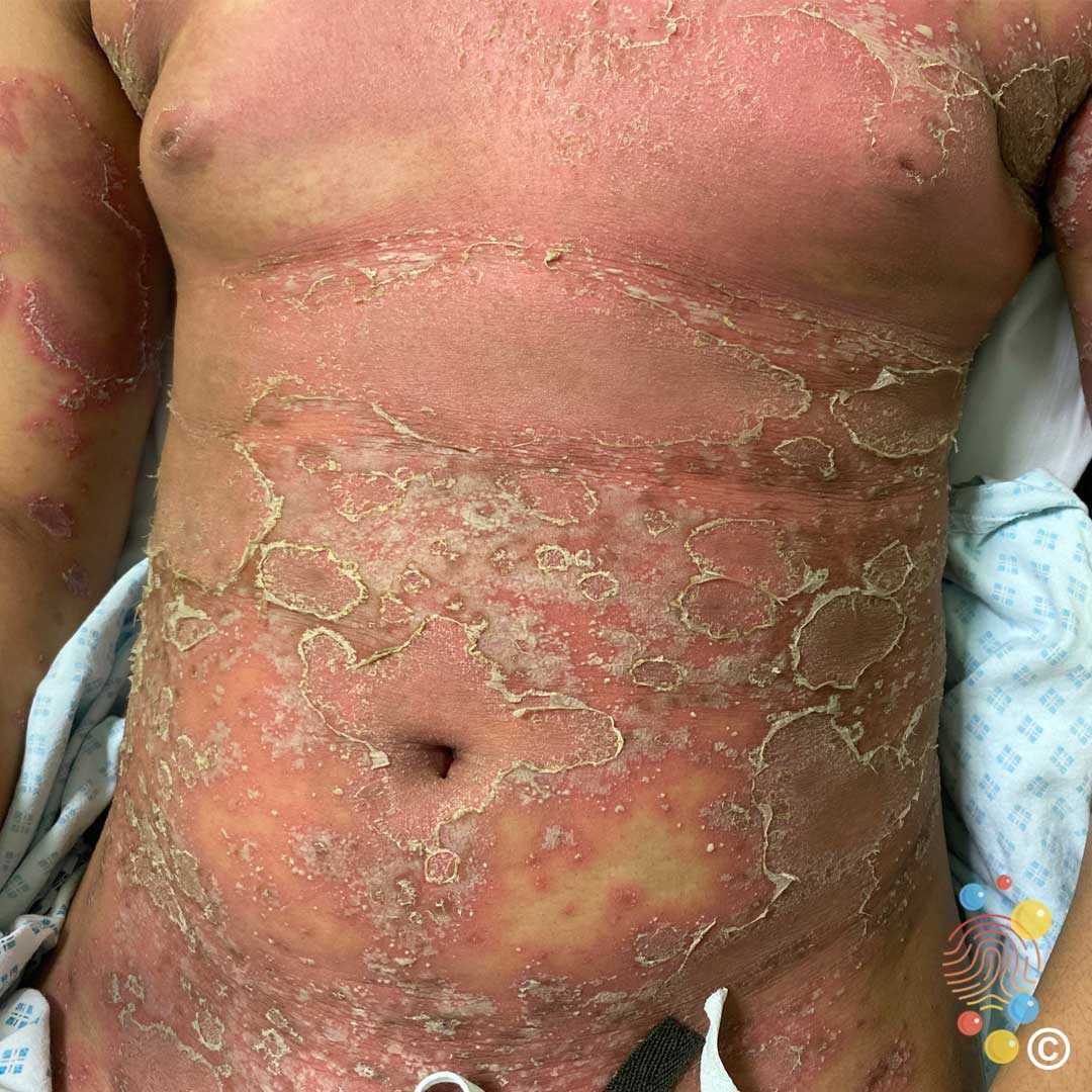 Pustular Psoriasis