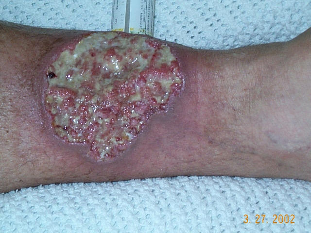 Pyoderma Gangrenosum