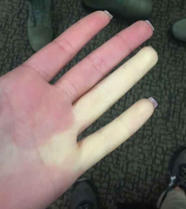 Raynaud’s syndrome