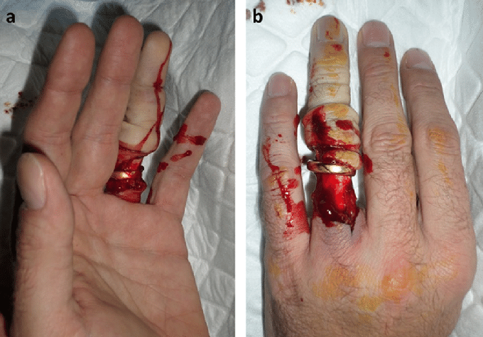 Ring Avulsion