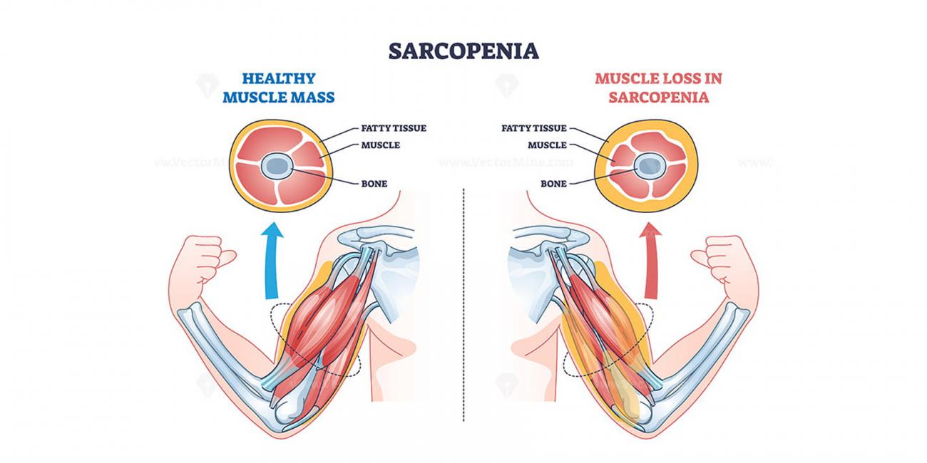 Sarcopenia