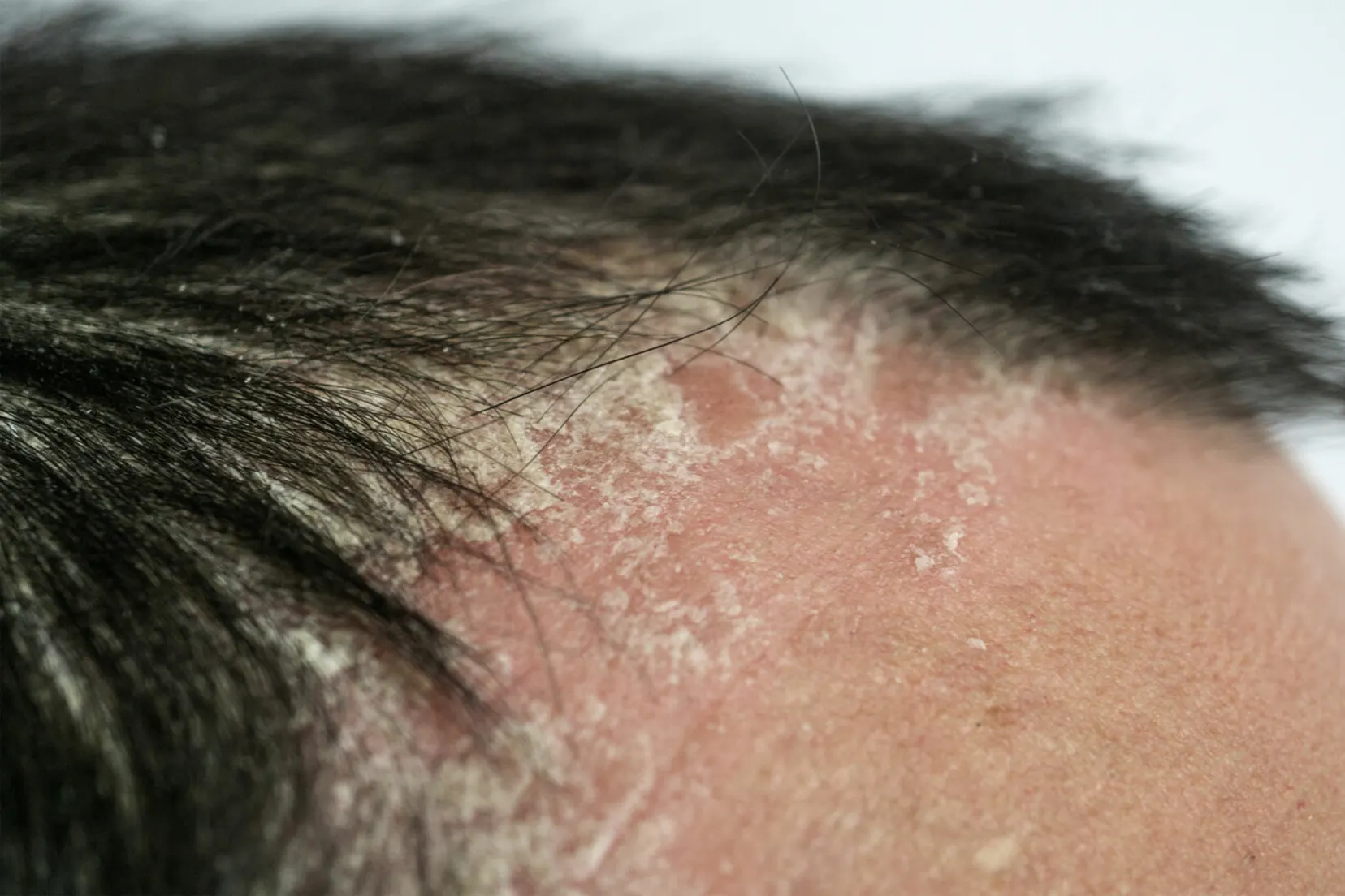 Scalp Psoriasis