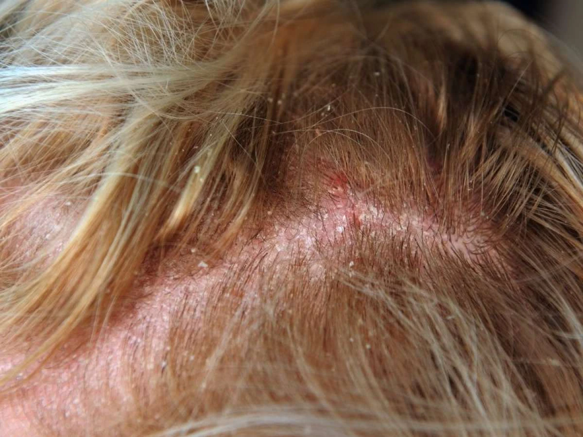 Scalp Yeast Infection