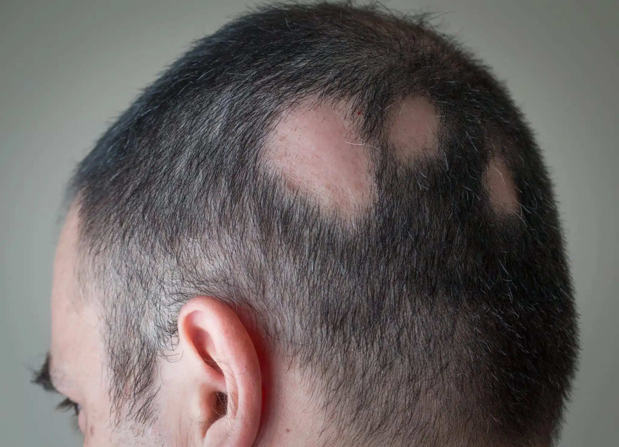 Scarring Alopecia