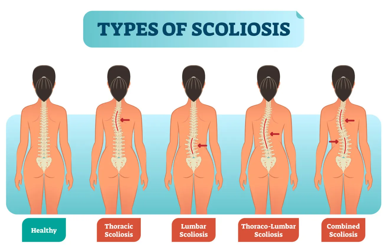 Scoliosis