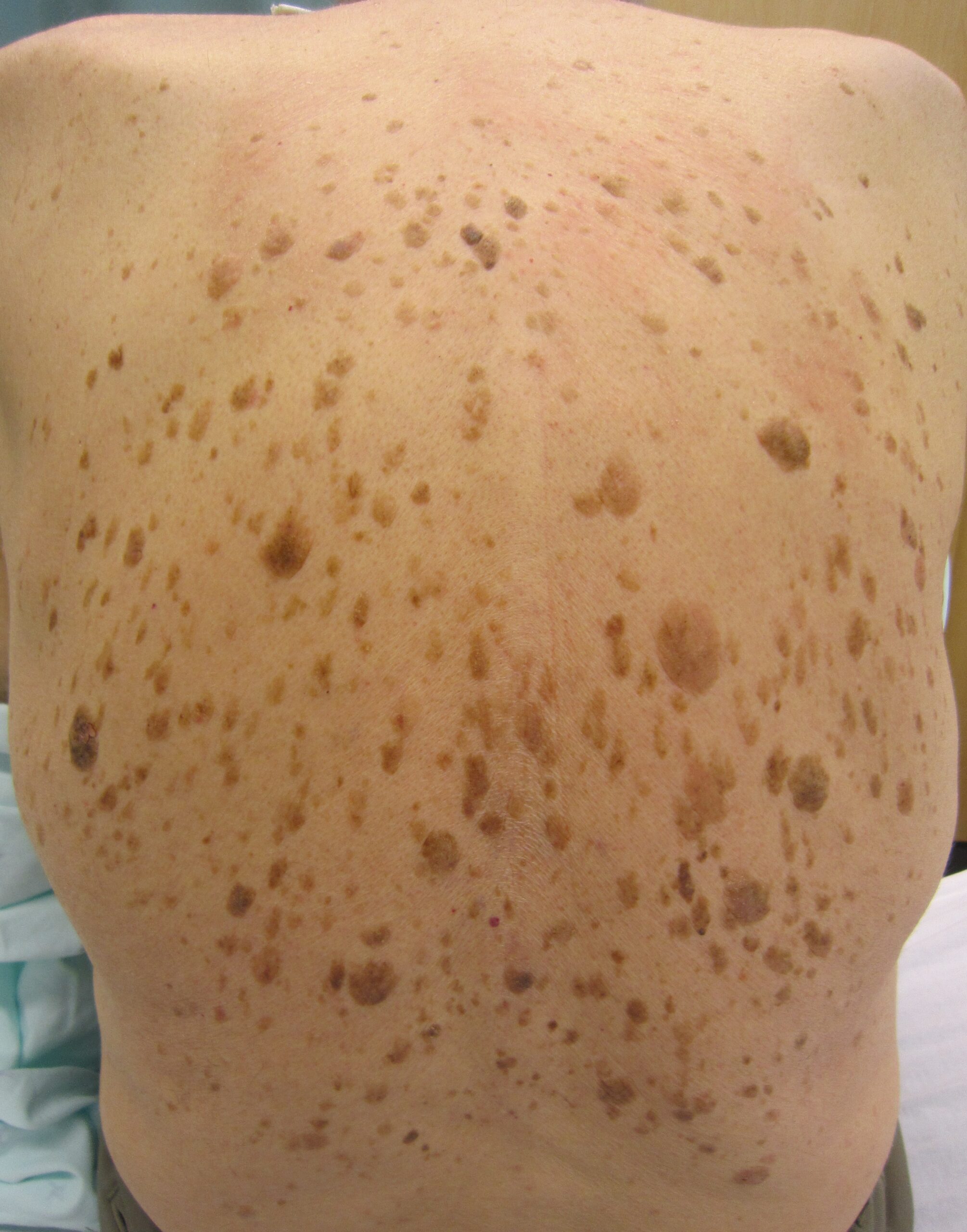 Seborrheic keratosis