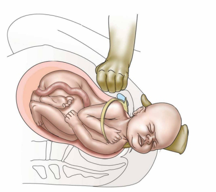 Shoulder Dystocia