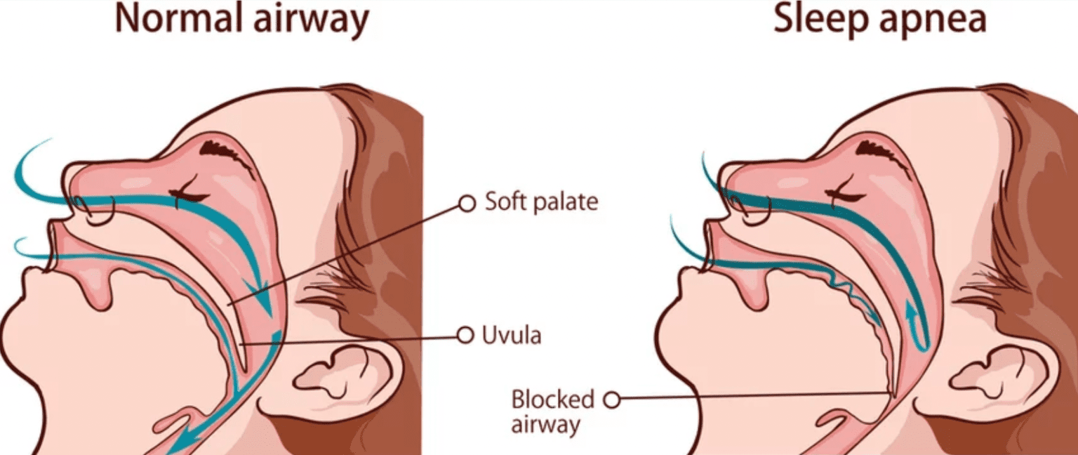 Sleep Apnea