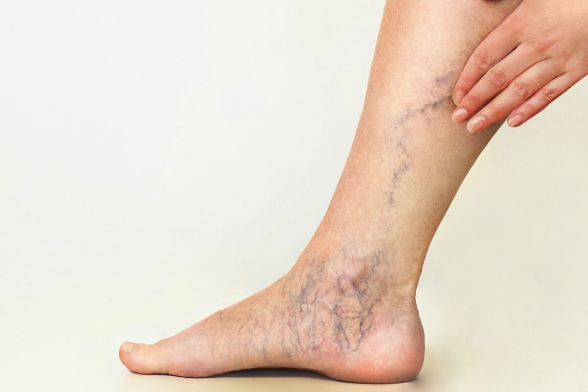 Spider Veins