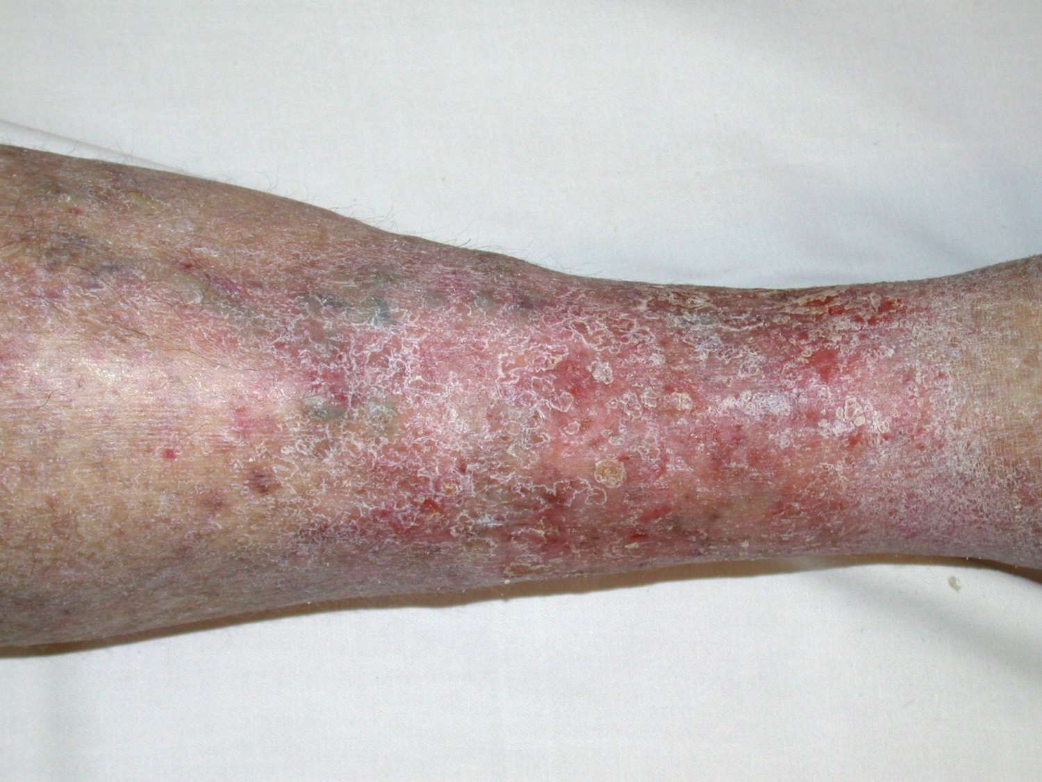 Venous Stasis Dermatitis: Symptoms, Causes, Treatment