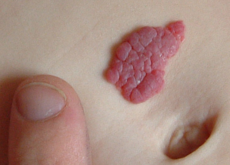 Strawberry Hemangiomas