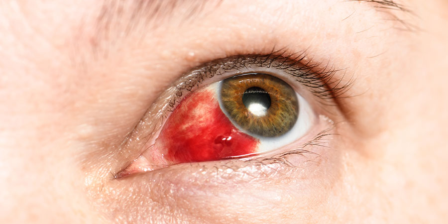 Subconjunctival Hemorrhage