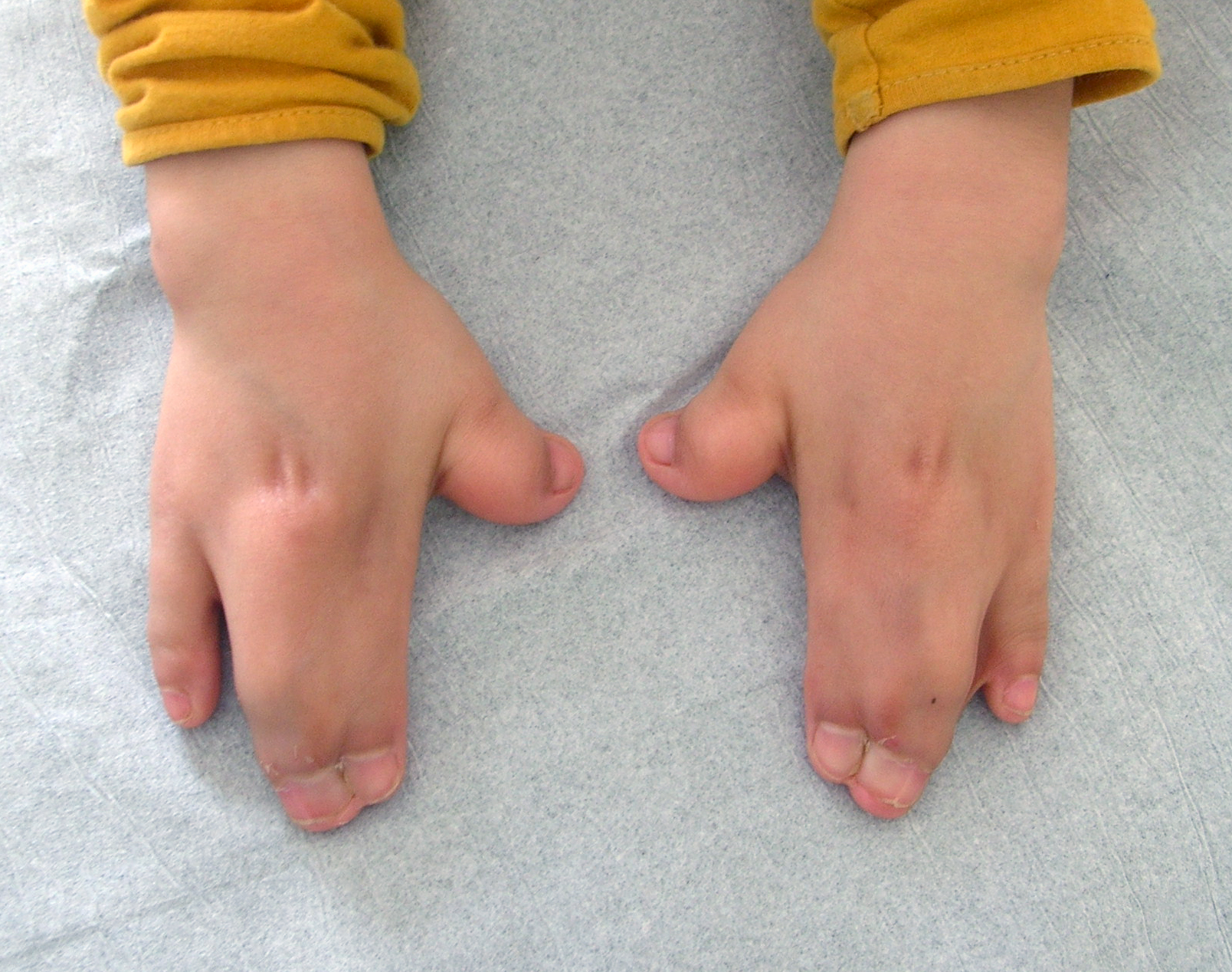 Syndactyly