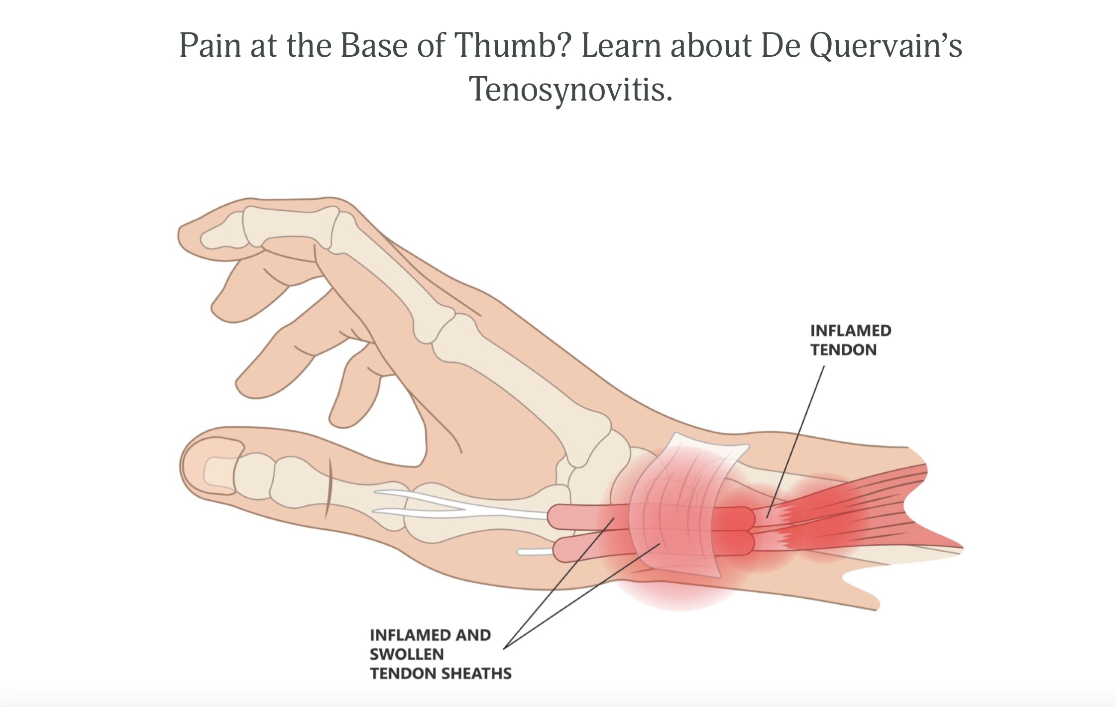 Tenosynovitis