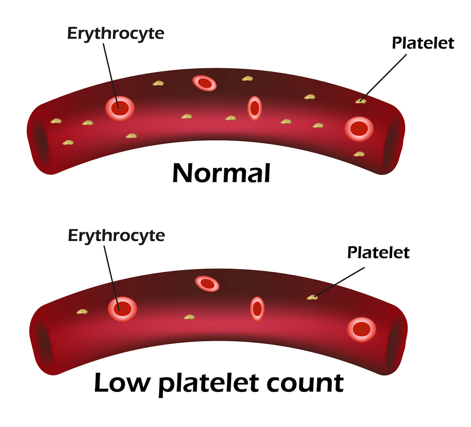 Thrombocytopenia