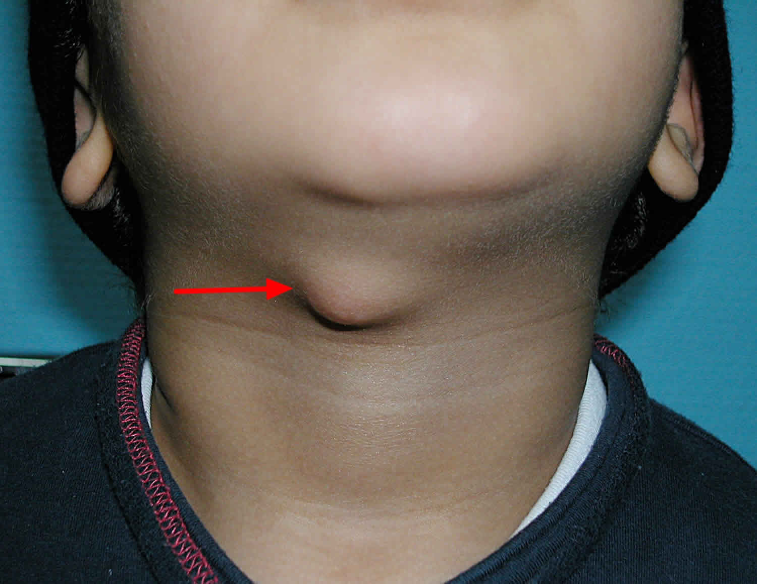 Thyroglossal duct cyst