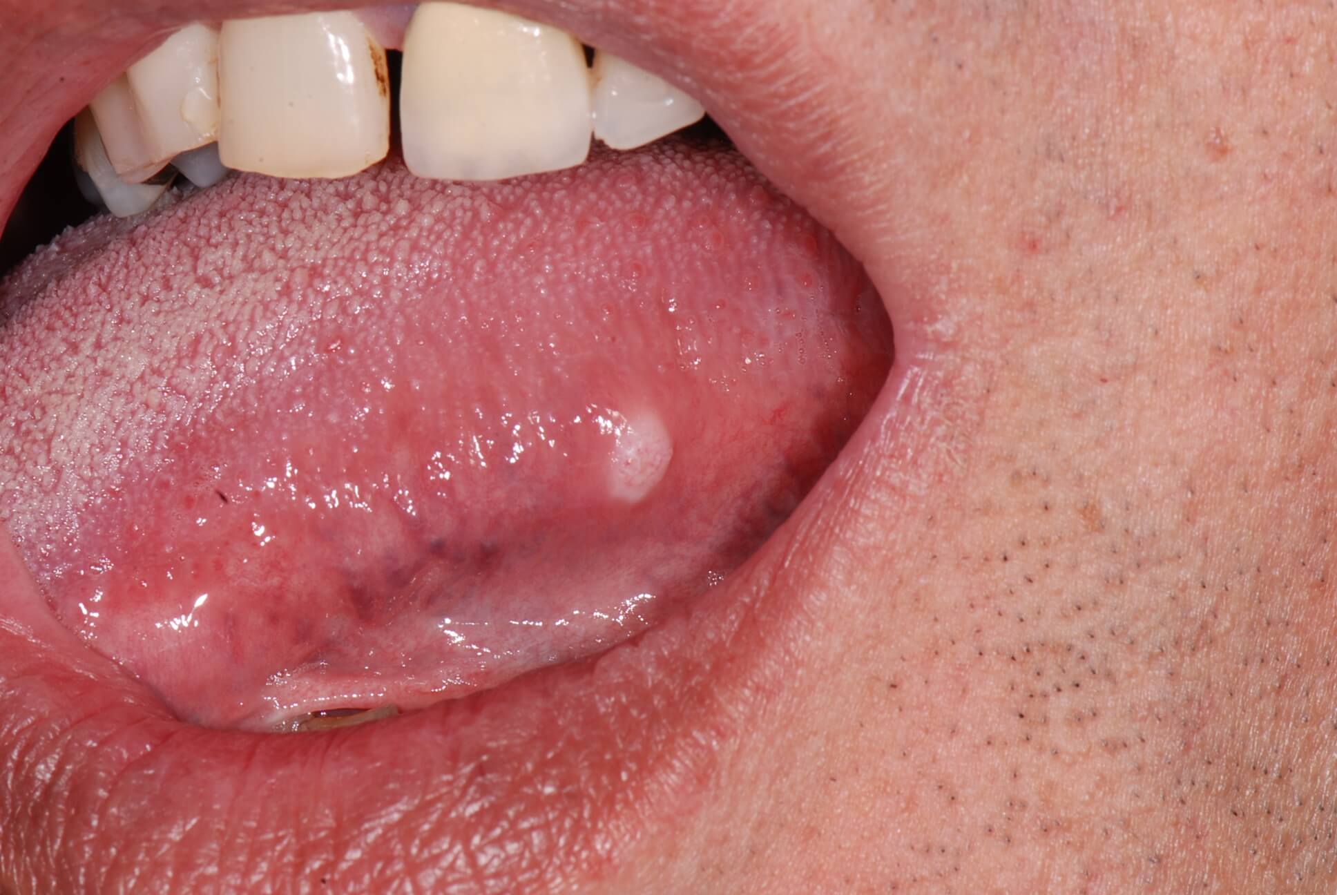 Tongue cancer