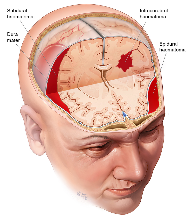 Traumatic Brain Injury