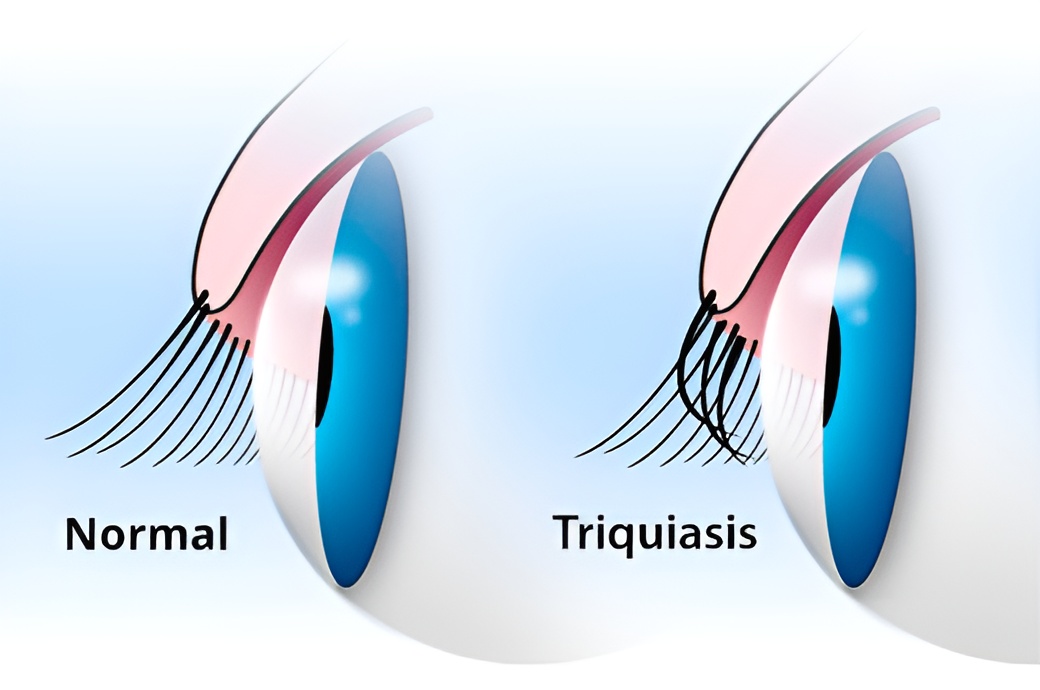 Trichiasis