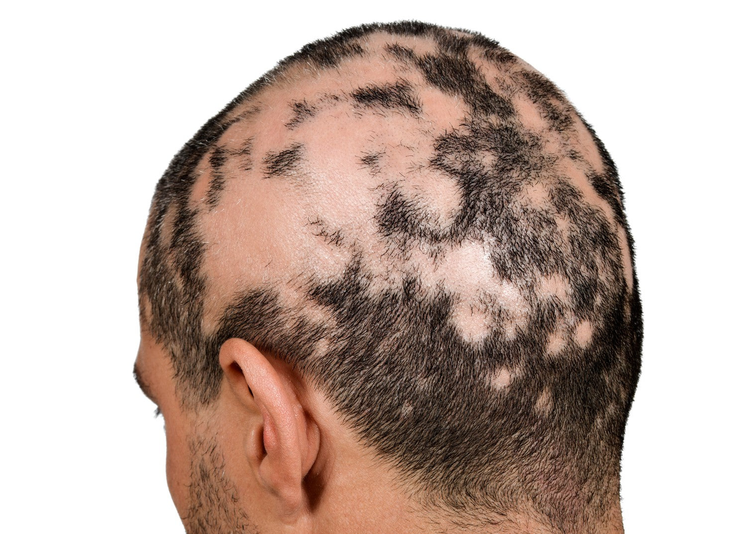 Trichotillomania