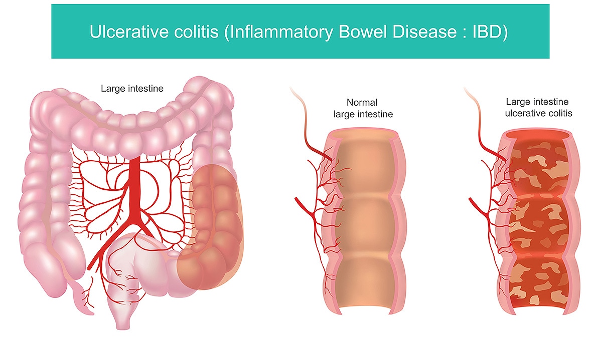 Ulcerative Colitis