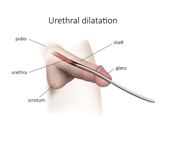 Urethral Stricture: Symptoms, Causes, Treatment